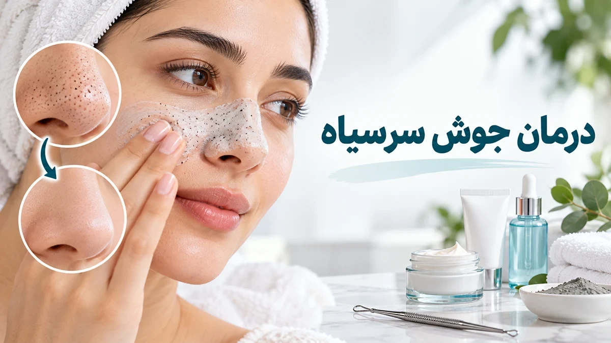 راهنمای درمان جوش سرسیاه: از روش های خانگی تا پزشکی
