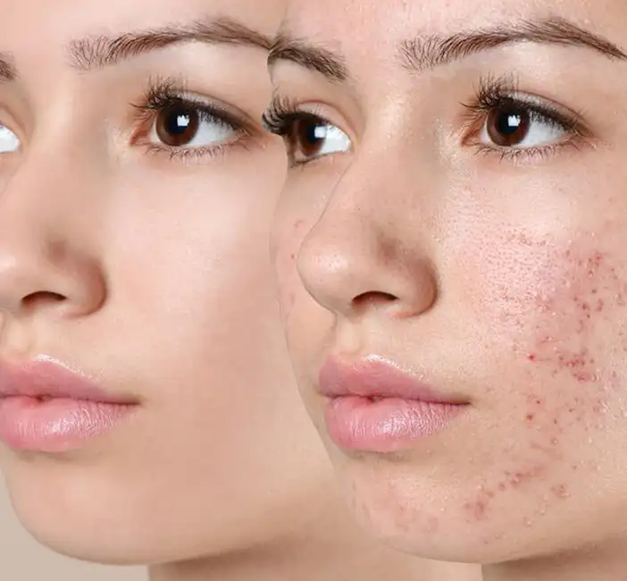 کاهش التهاب و کمک به درمان جوش و آکنه